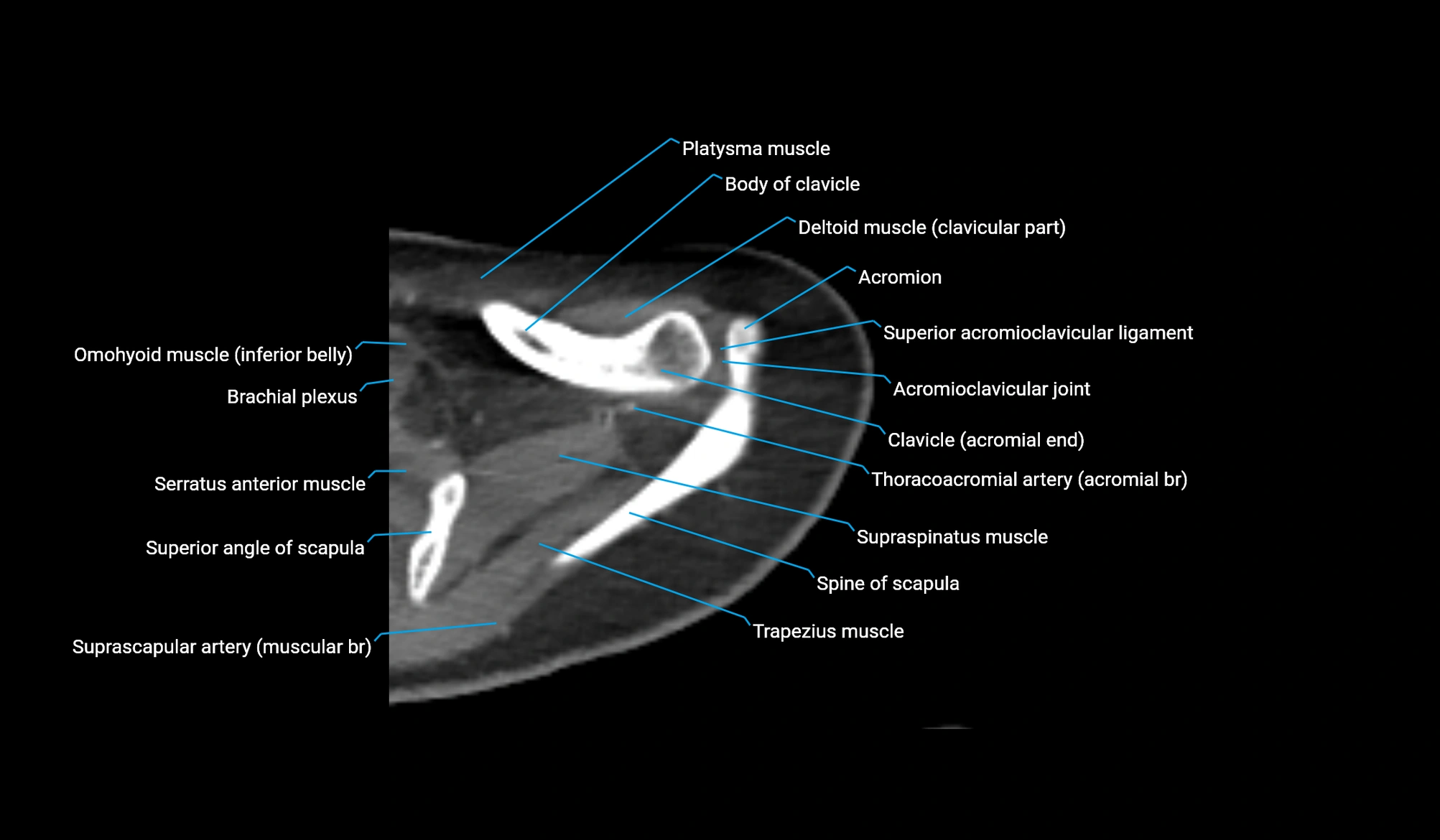 CT upper arm axial  cross sectional anatomy labelled radiology image -00060.webp